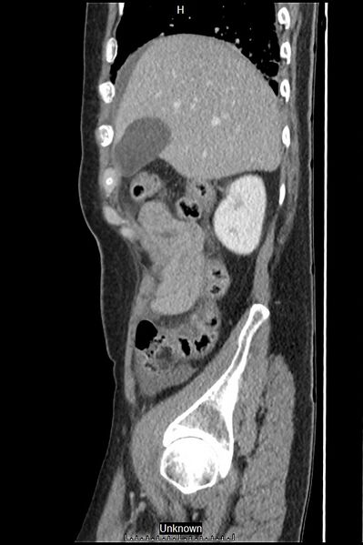 File:Closed loop bowel obstruction and ischemia (Radiopaedia 86959-103180 C 54).jpg