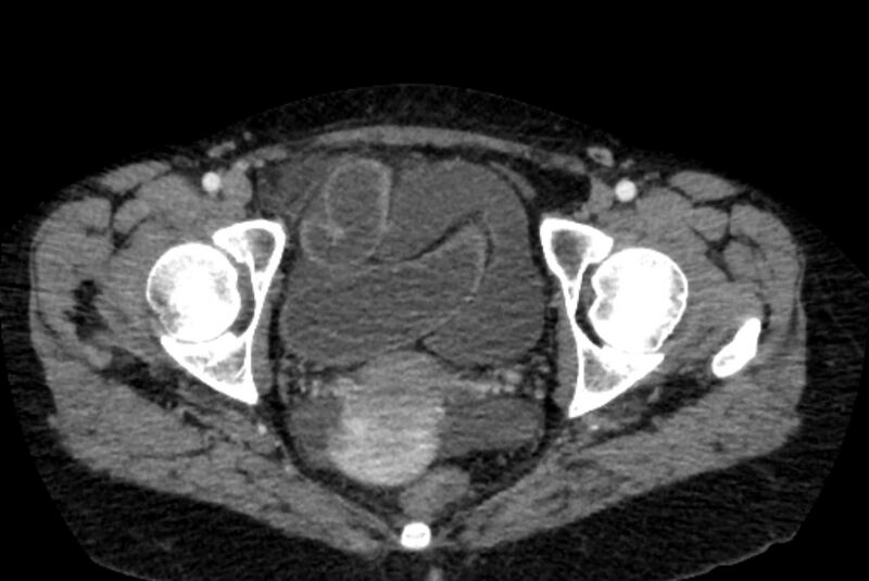 File:Closed loop small bowel obstruction (Radiopaedia 71211-81508 A 160).jpg