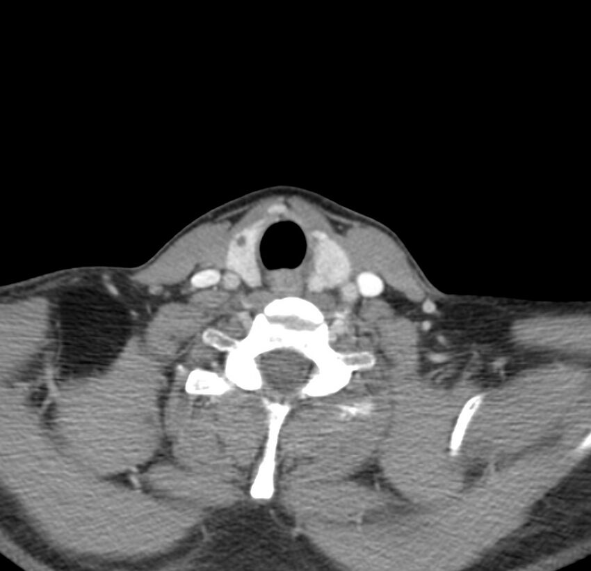 Colloid cyst of thyroid (Radiopaedia 22897-22923 Axial C+ delayed 58).jpg