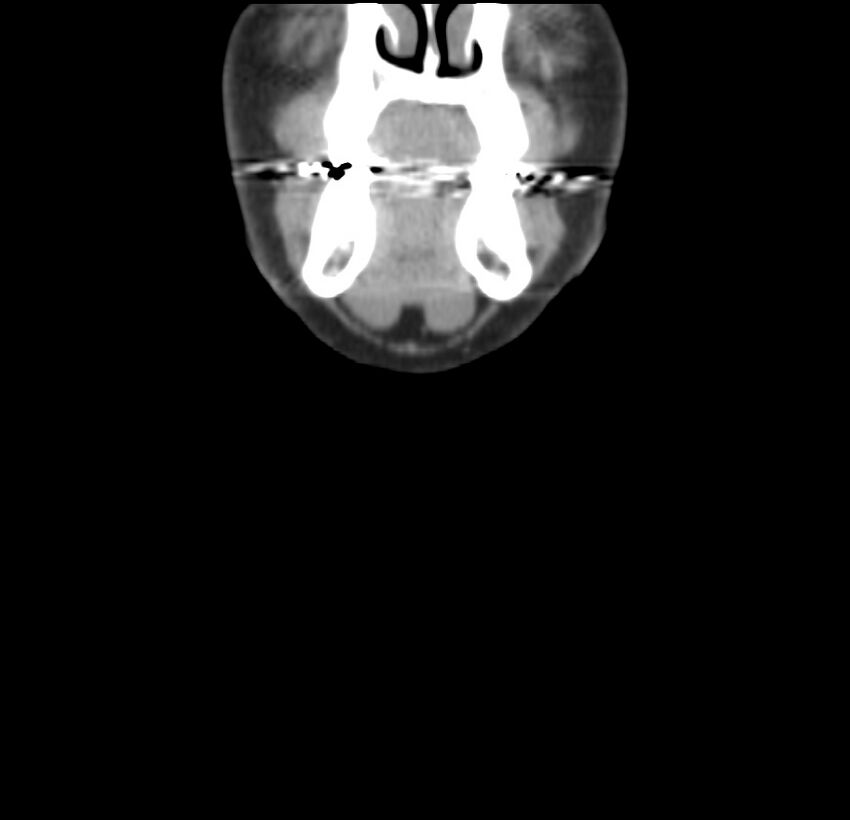 Colloid cyst of thyroid (Radiopaedia 22897-22923 Coronal C+ delayed 7).jpg