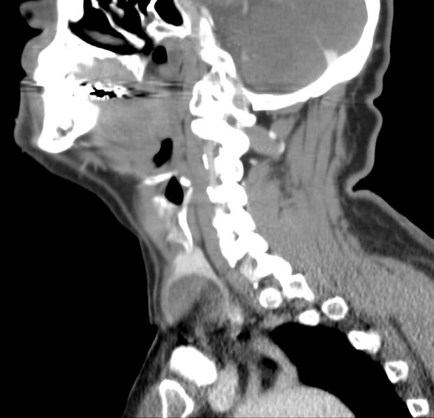 File:Colloid cyst of thyroid (Radiopaedia 22897-22923 Sagittal C+ delayed 36).jpg