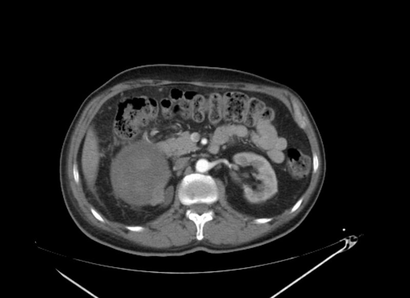 File:Colon cancer mimicking renal cell carcinoma (Radiopaedia 28986-29335 B 30).jpg