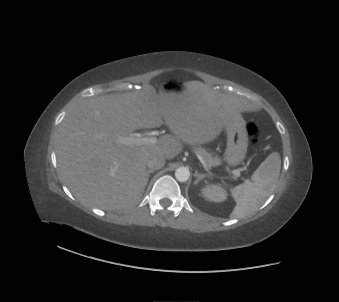 File:Colonic pseudo-obstruction (Radiopaedia 79752-92980 A 47).png