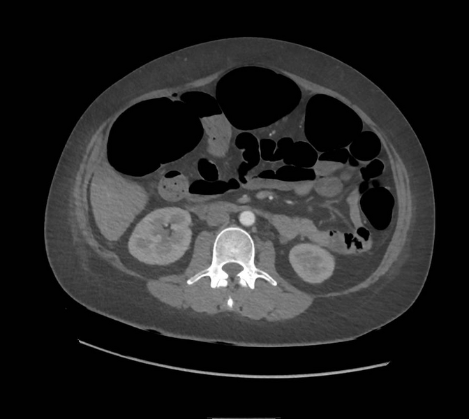 File:Colonic pseudo-obstruction (Radiopaedia 79752-92980 A 88).png