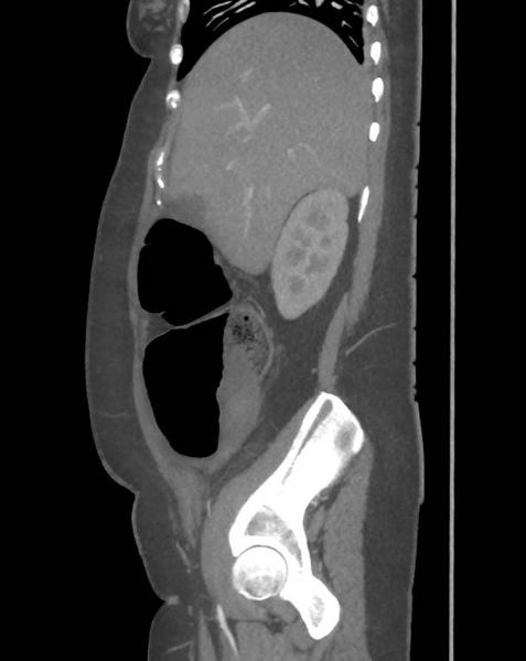 File:Colonic pseudo-obstruction (Radiopaedia 79752-92980 C 23).png
