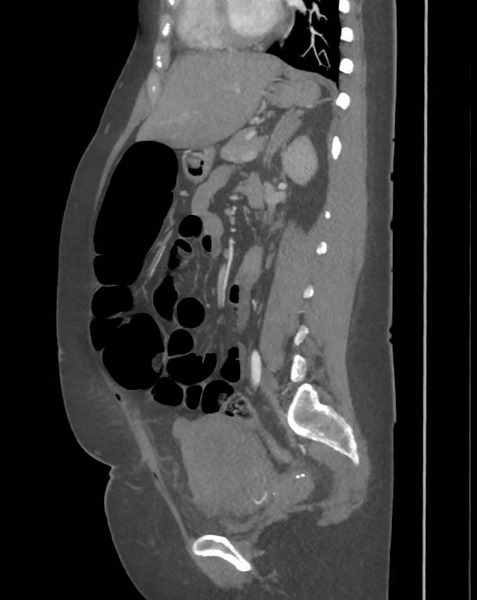 File:Colonic pseudo-obstruction (Radiopaedia 79752-92980 C 46).png