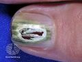 Green nail due to pseudomonas