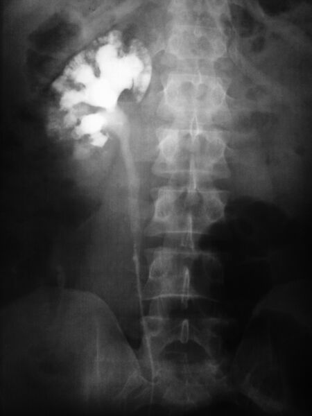 File:Medullary sponge kidney on IVP (Radiopaedia 21065).jpg