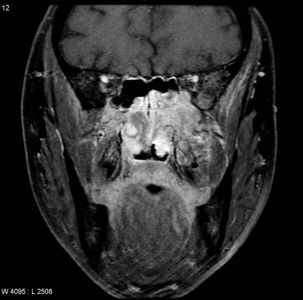 File:Nasopharyngeal carcinoma (Radiopaedia 4546-6667 E 2).jpg