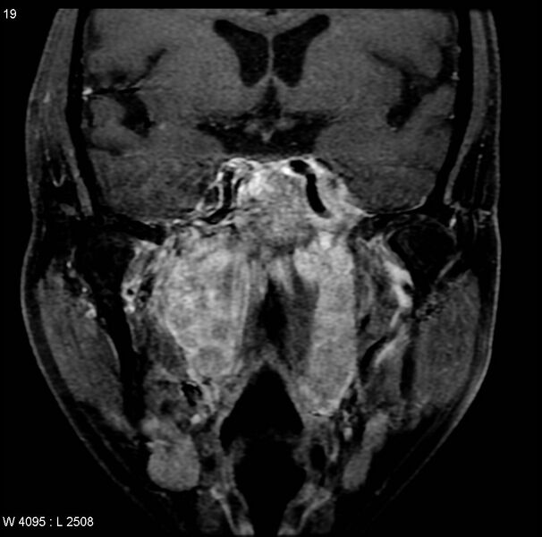 File:Nasopharyngeal carcinoma (Radiopaedia 4546-6667 E 9).jpg