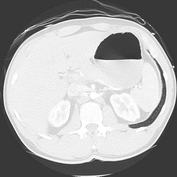 File:Near drowning pulmonary edema (Radiopaedia 16868-16591 Axial lung window 57).jpg
