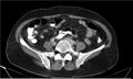 Necrotizing pancreatitis (Radiopaedia 20595-20495 A 30).jpg