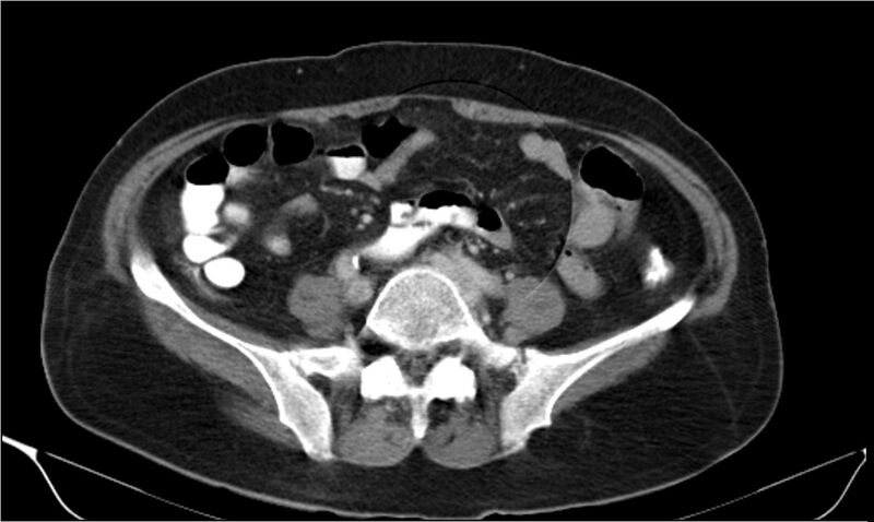 File:Necrotizing pancreatitis (Radiopaedia 20595-20495 A 30).jpg