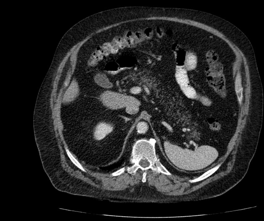 Nephroptosis with inguinal hernia containing perirenal fat (Radiopaedia 56632-63391 C 104).jpg
