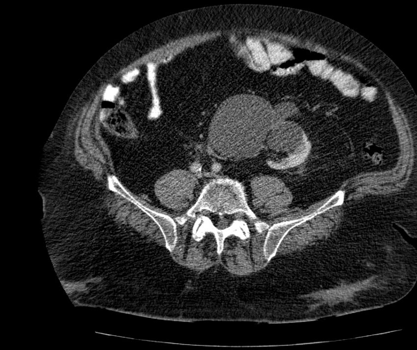 Nephroptosis with inguinal hernia containing perirenal fat (Radiopaedia 56632-63391 C 234).jpg