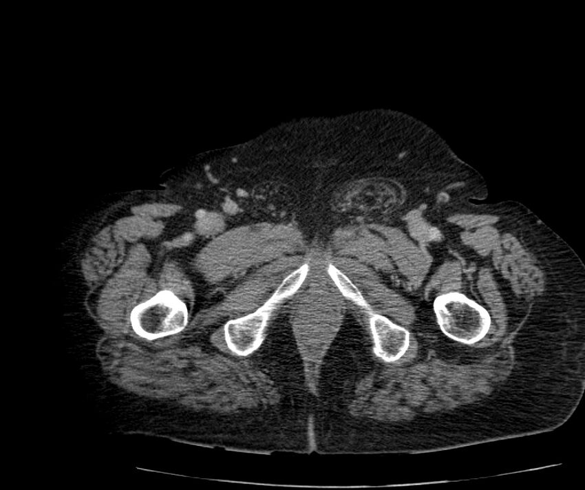 Nephroptosis with inguinal hernia containing perirenal fat (Radiopaedia 56632-63391 C 345).jpg