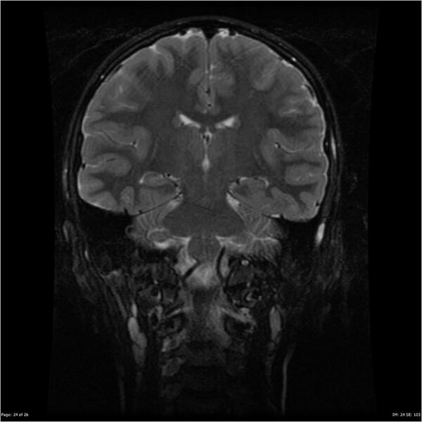 File:Neurofibromatosis type 1 (Radiopaedia 22541-22564 Coronal T2 fat sat 15).jpg