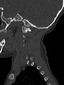 Normal CT cervical spine - pediatric (Radiopaedia 52549-58462 Sagittal bone window 192).jpg