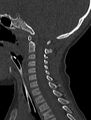 Normal CT cervical spine - pediatric (Radiopaedia 52549-58462 Sagittal bone window 89).jpg