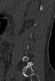 Normal CT lumbar spine (Radiopaedia 53981-60118 Sagittal bone window 14).jpg
