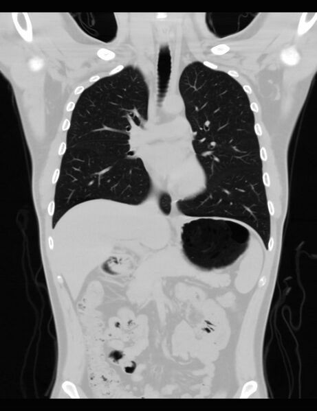 File:Normal CT virtual gastroscopy (Radiopaedia 29960-30501 F 8).jpg