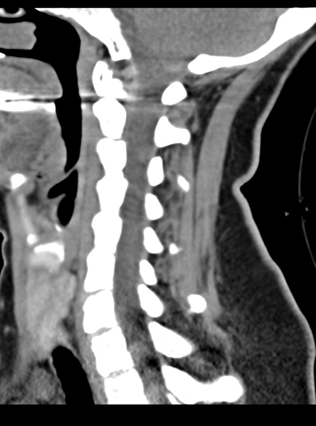 File:Normal cervical spine MRI (including Dixon) (Radiopaedia 42762-45926 C 36).png