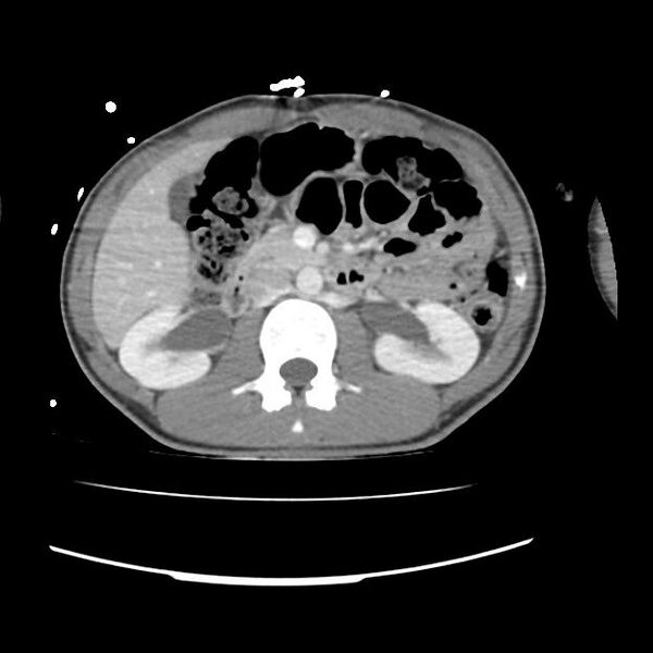 File:Normal dual-phase trauma CT chest,abdomen and pelvis (Radiopaedia 48092-52899 A 65).jpg