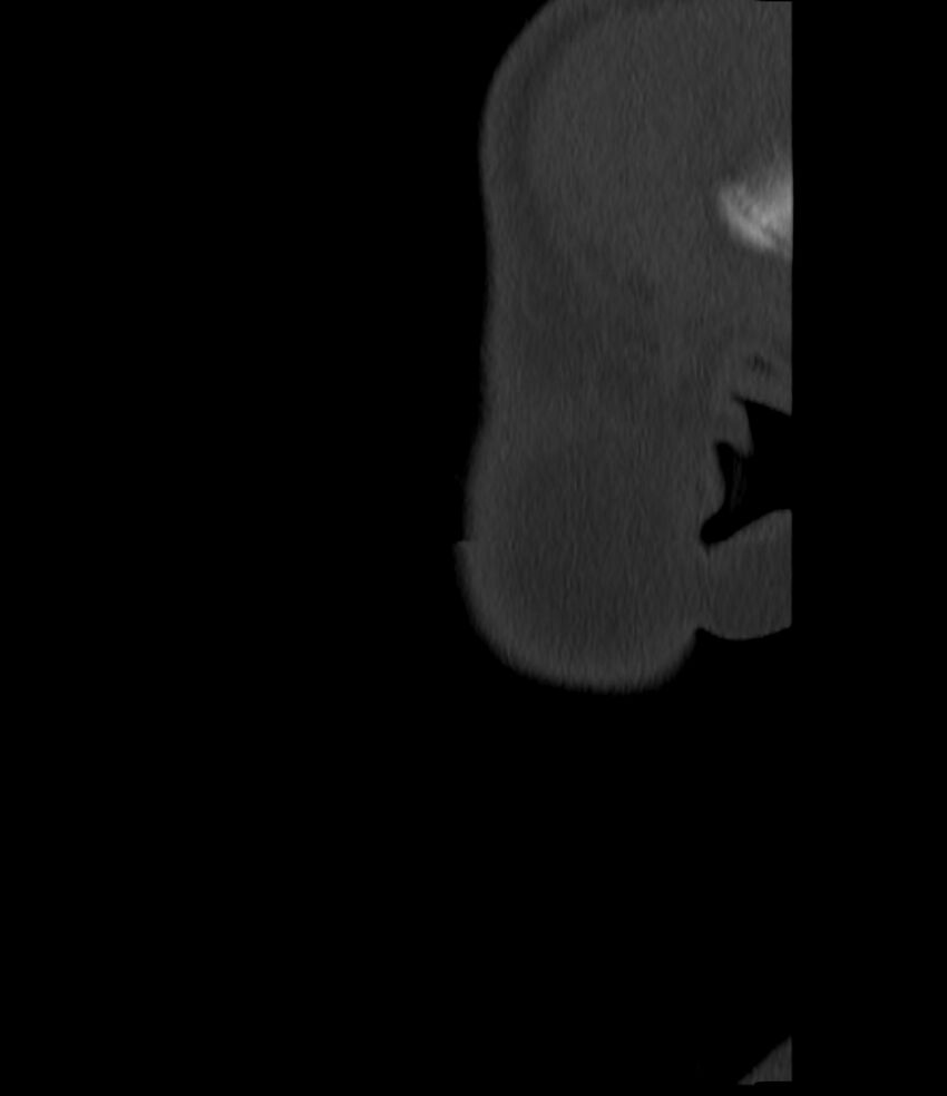 Normal facial bone CT (Radiopaedia 88742-105476 Sagittal bone window 11).jpg