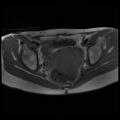 Normal female pelvis MRI (retroverted uterus) (Radiopaedia 61832-69933 Axial T1 18).jpg