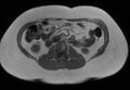 Normal liver MRI with Gadolinium (Radiopaedia 58913-66163 Axial T1 in-phase 7).jpg