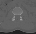 Normal lumbar spine CT (Radiopaedia 46533-50986 Axial bone window 20).png