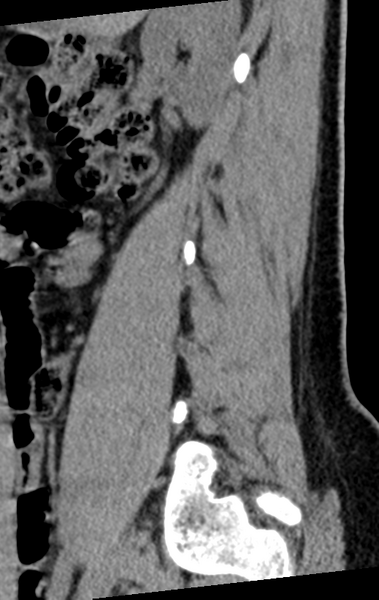 File:Normal lumbar spine CT (Radiopaedia 46533-50986 C 82).png