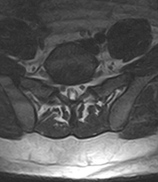 File:Normal lumbar spine MRI - low-field MRI scanner (Radiopaedia 40976-43699 Axial T2 87).jpg