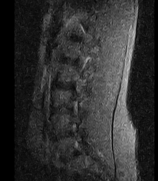 File:Normal lumbar spine MRI - low-field MRI scanner (Radiopaedia 40976-43699 Sagittal STIR 3).jpg