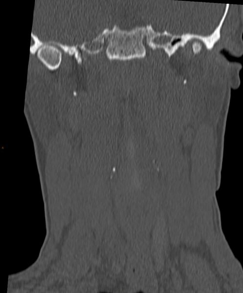 File:Occipital condyle fracture (Radiopaedia 61165-69056 Coronal bone window 13).jpg