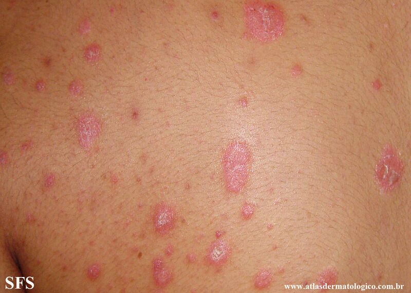 File:Psoriasis (Dermatology Atlas 151).jpg