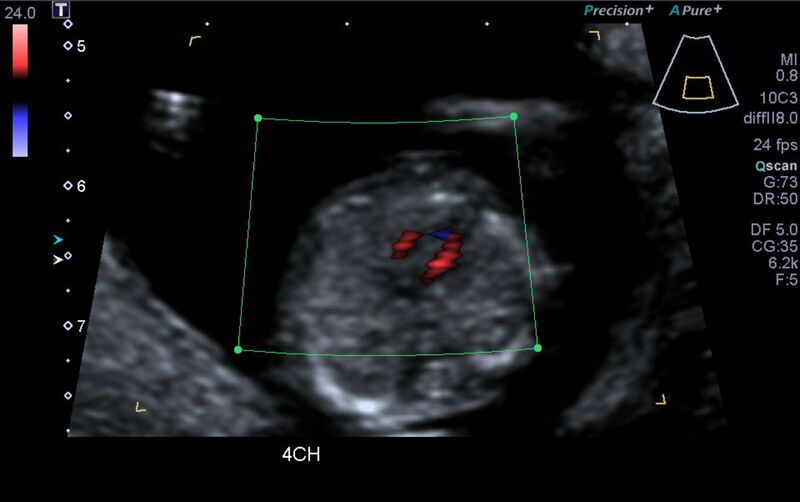 File:1st trimester nuchal-morphology ultrasound (Radiopaedia 44706-48477 Heart views cine with colour 53).jpg