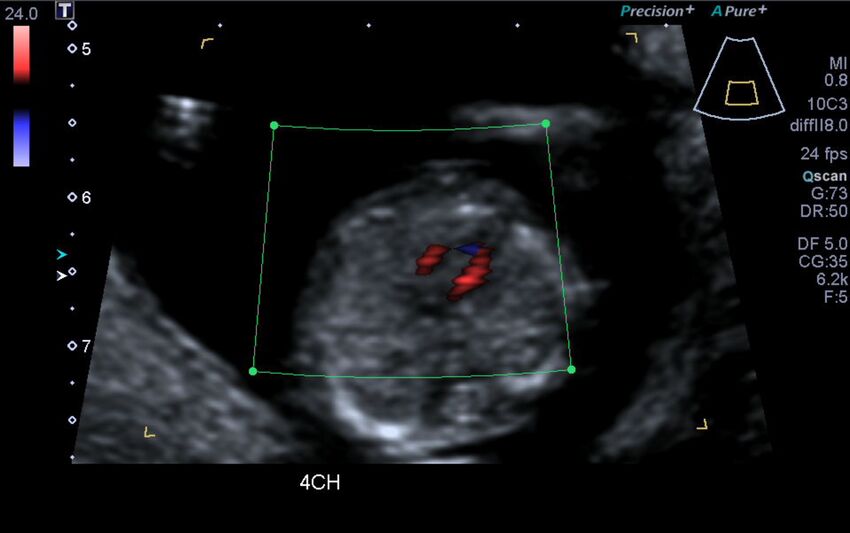 1st trimester nuchal-morphology ultrasound (Radiopaedia 44706-48477 Heart views cine with colour 53).jpg