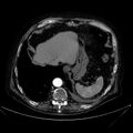 Abdominal aortic aneurysm (Radiopaedia 25855-26001 Axial C+ arterial phase 23).jpg