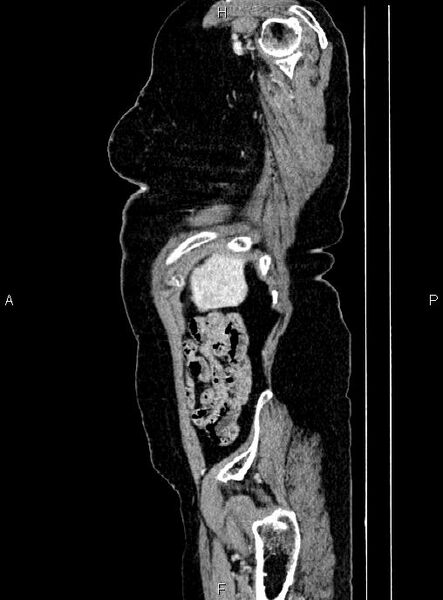 File:Abdominal aortic aneurysm (Radiopaedia 85063-100606 Sagittal C+ arterial phase 76).jpg