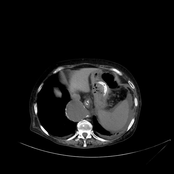 File:Abdominal aortic aneurysm - impending rupture (Radiopaedia 19233-19246 Axial non-contrast 23).jpg