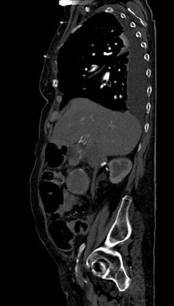 File:Abdominal aortic aneurysm with thrombus fissuration (Radiopaedia 73192-83919 Sagittal C+ arterial phase 101).jpg