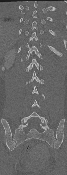 File:Abdominal multi-trauma - devascularised kidney and liver, spleen and pancreatic lacerations (Radiopaedia 34984-36486 Coronal bone window 51).png