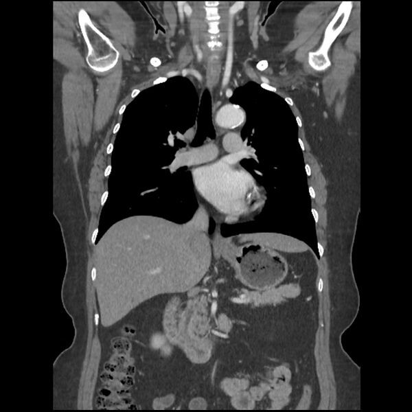 File:Aberrant right subclavian and left vertebral arteries (Radiopaedia 43467-46847 Coronal C+ portal venous phase 44).jpg