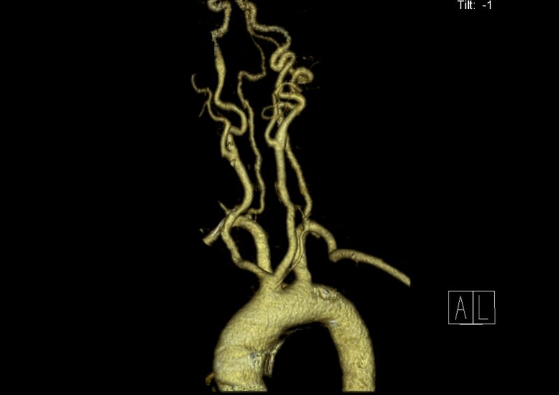 File:Aberrant right subclavian artery (Radiopaedia 19283-19294 3D reconstruction C+ arterial phase 10).jpg