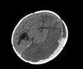 Abusive head trauma (Radiopaedia 70205-80252 Axial non-contrast 17).jpg