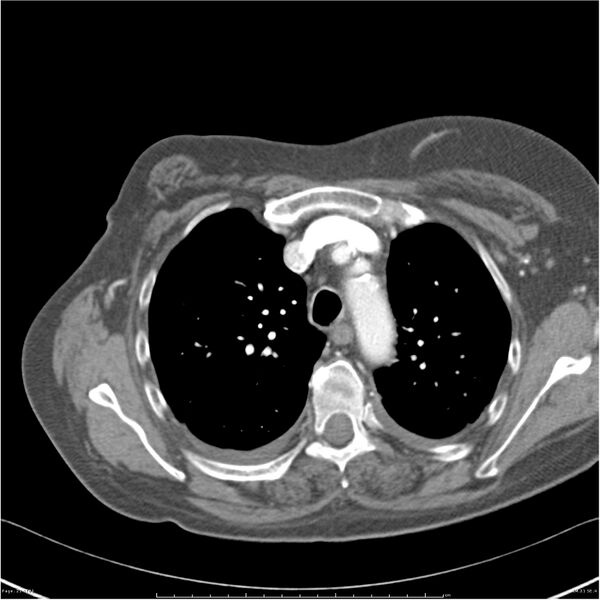 File:Acute-on-chronic pulmonary emboli (Radiopaedia 27925-28169 C+ CTPA 21).jpg