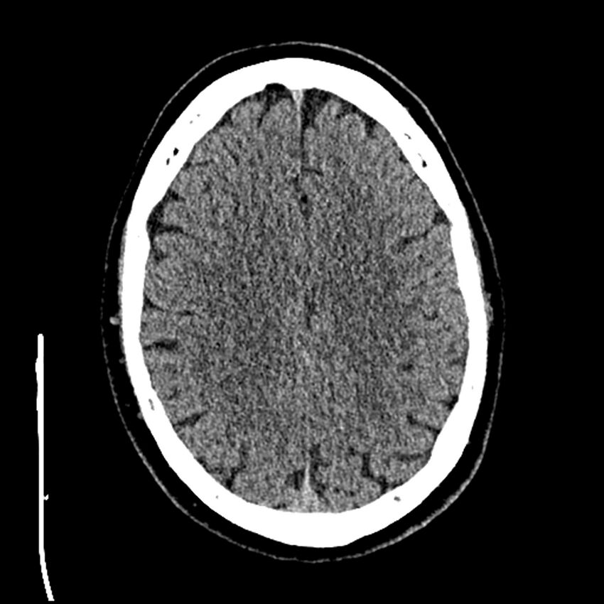 Acute A3 occlusion with ACA ischemic penumbra (CT perfusion) (Radiopaedia 72036-82525 Axial non-contrast thins 73).jpg