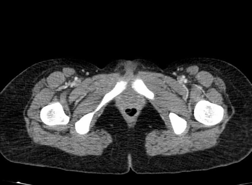 Acute Budd-Chiari syndrome (Radiopaedia 60858-68638 Axial C+ portal venous phase 312).jpg