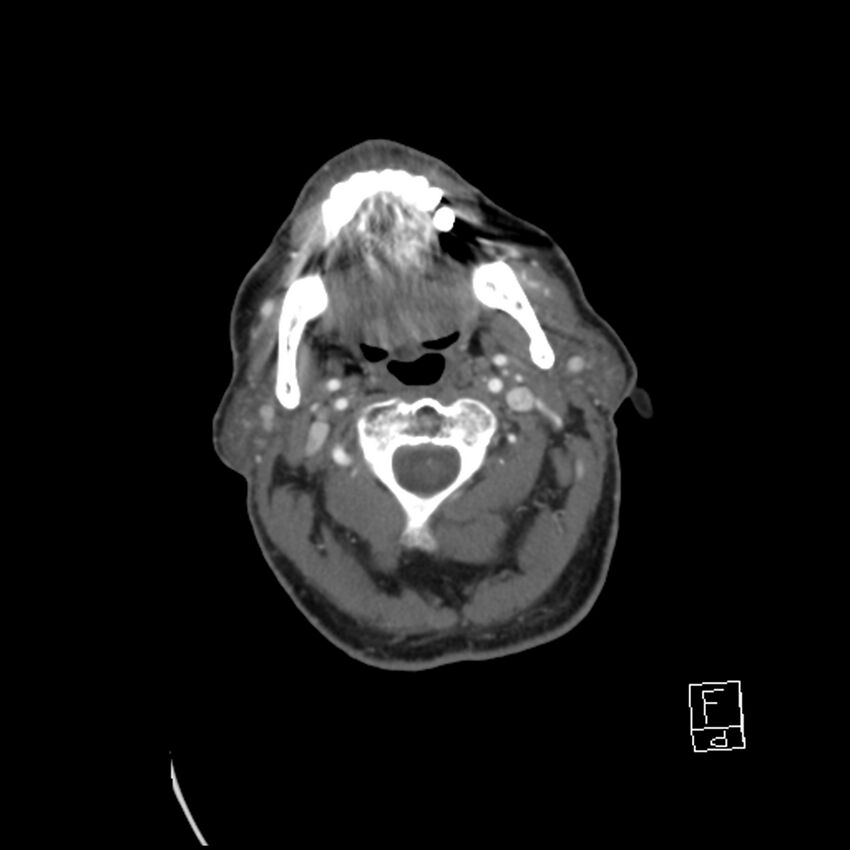 Acute ICA ischemic penumbra due to high-grade CCA stenosis (CT perfusion) (Radiopaedia 72038-82530 Axial C+ arterial phase 33).jpg